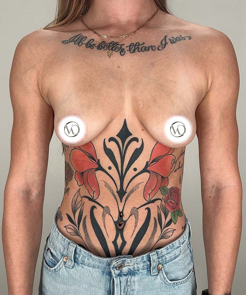 Breast Augmentation Before & After