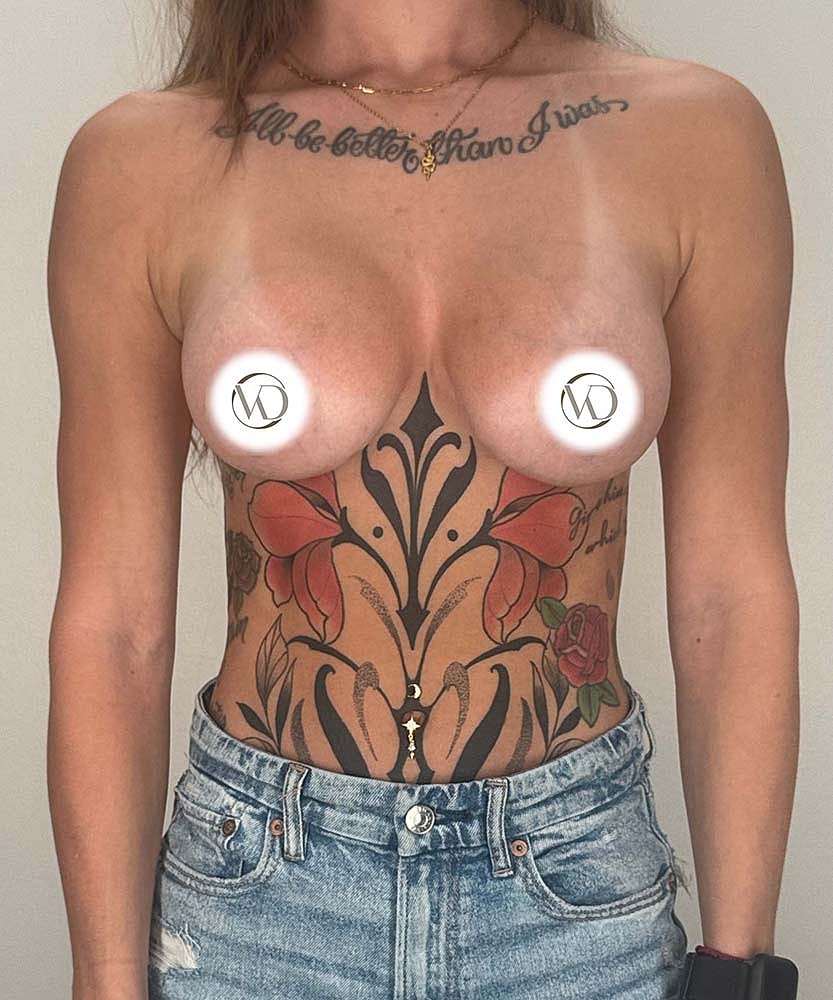 Breast Augmentation Before & After