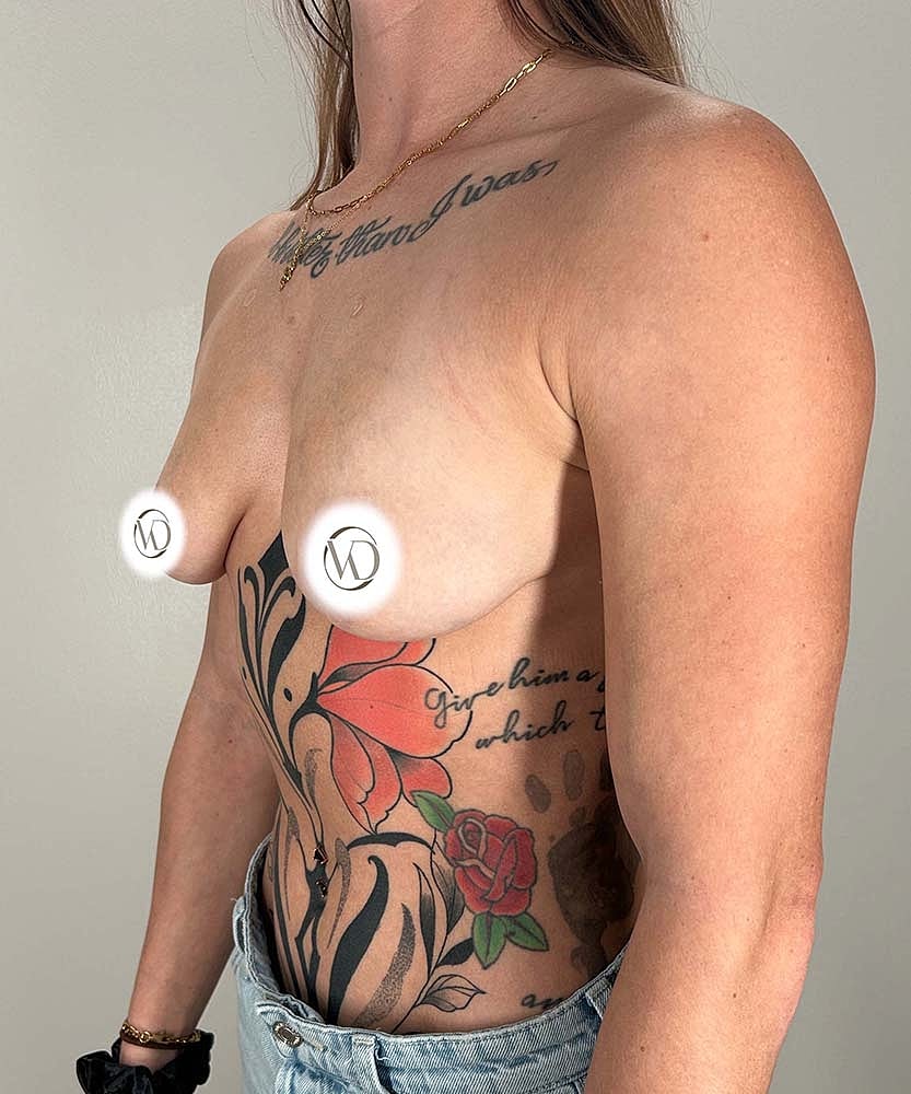 Breast Augmentation Before & After