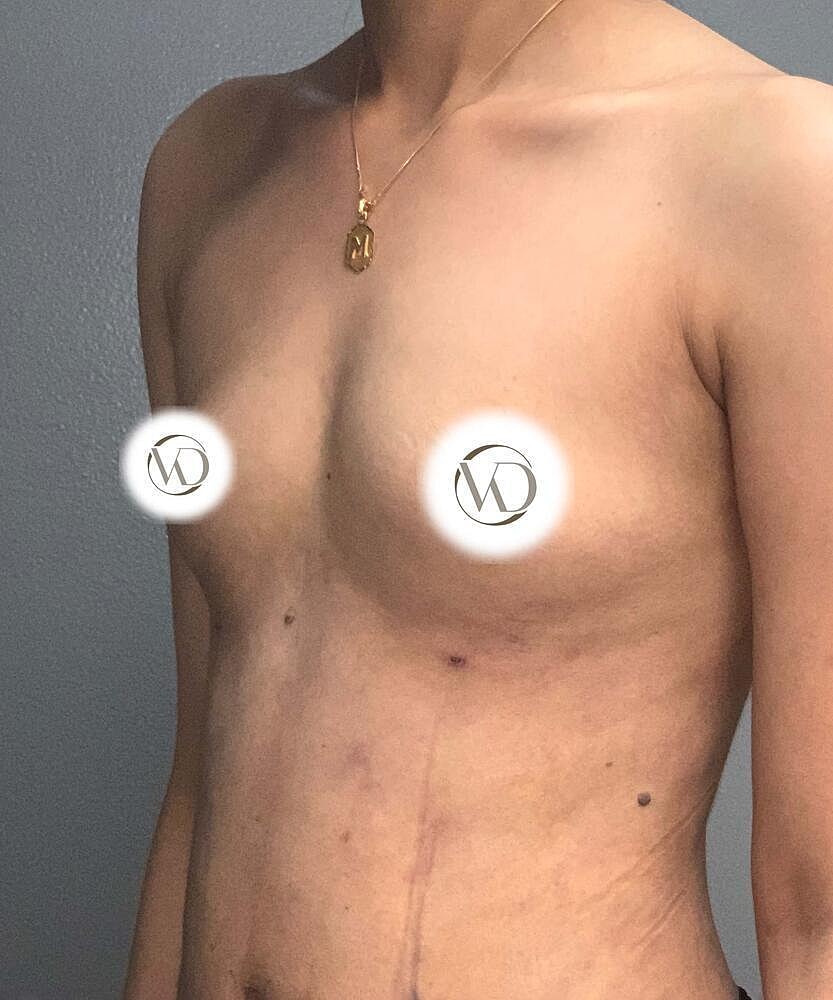 Breast Augmentation Before & After