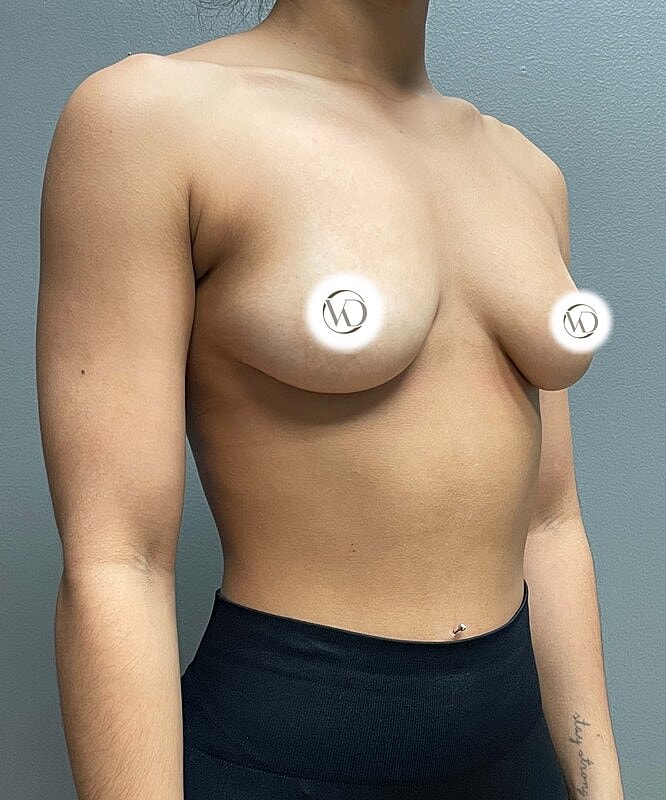Breast Augmentation Before & After
