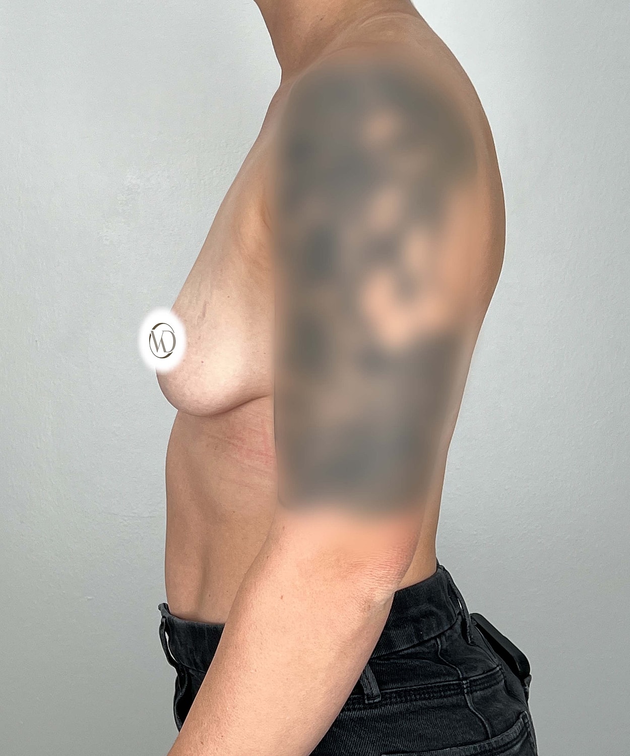 Breast Augmentation Gallery Before & After
