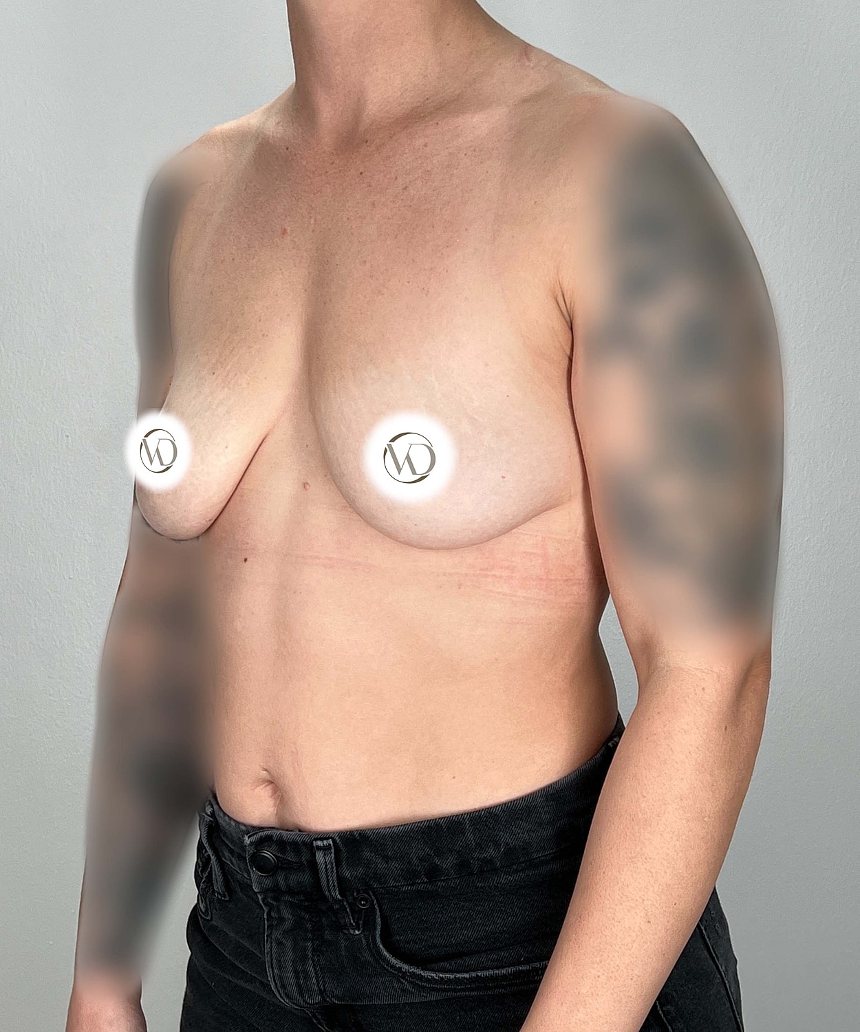 Breast Augmentation Gallery Before & After