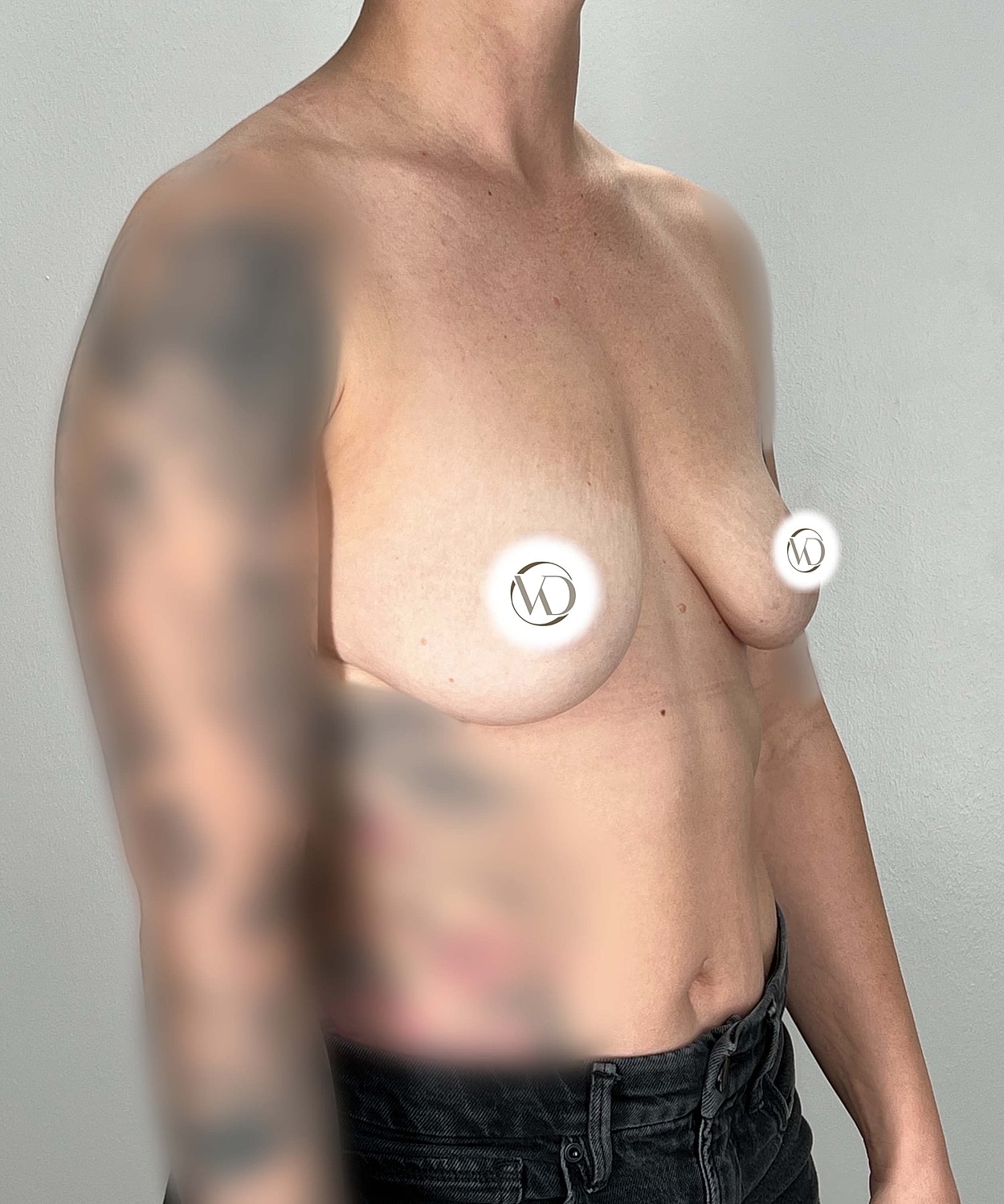 Breast Augmentation Gallery Before & After