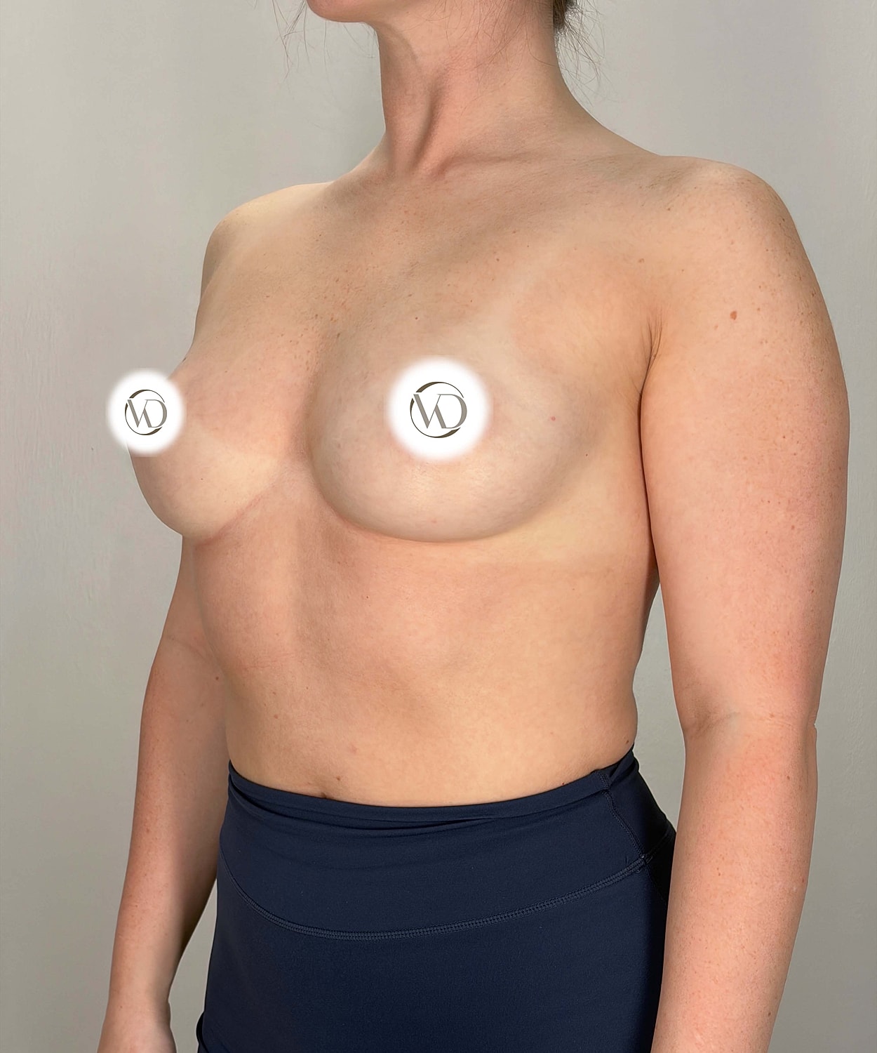 Breast Augmentation Gallery Before & After