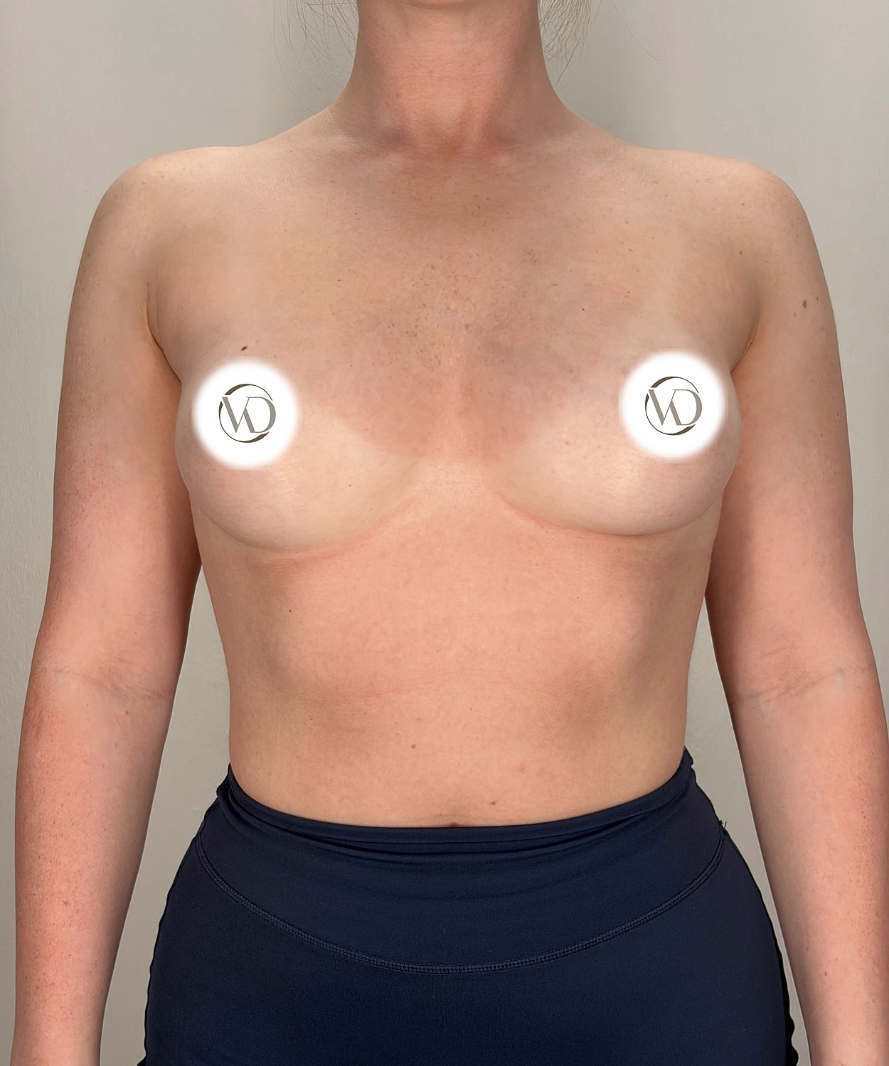 Breast Augmentation Gallery Before & After