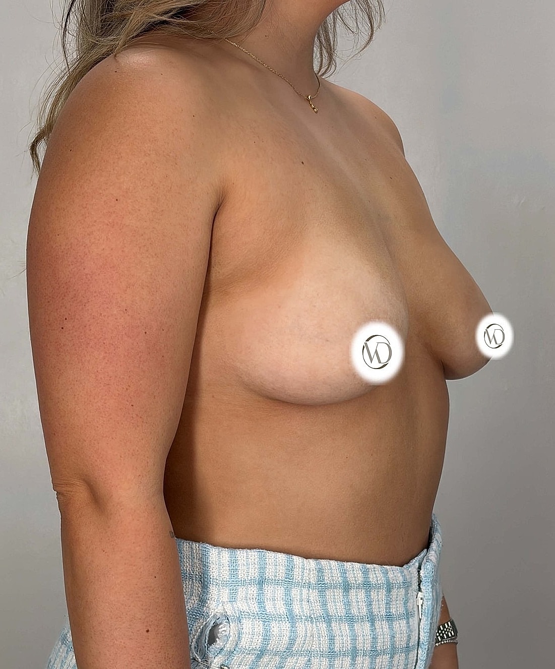 Breast Augmentation Gallery Before & After