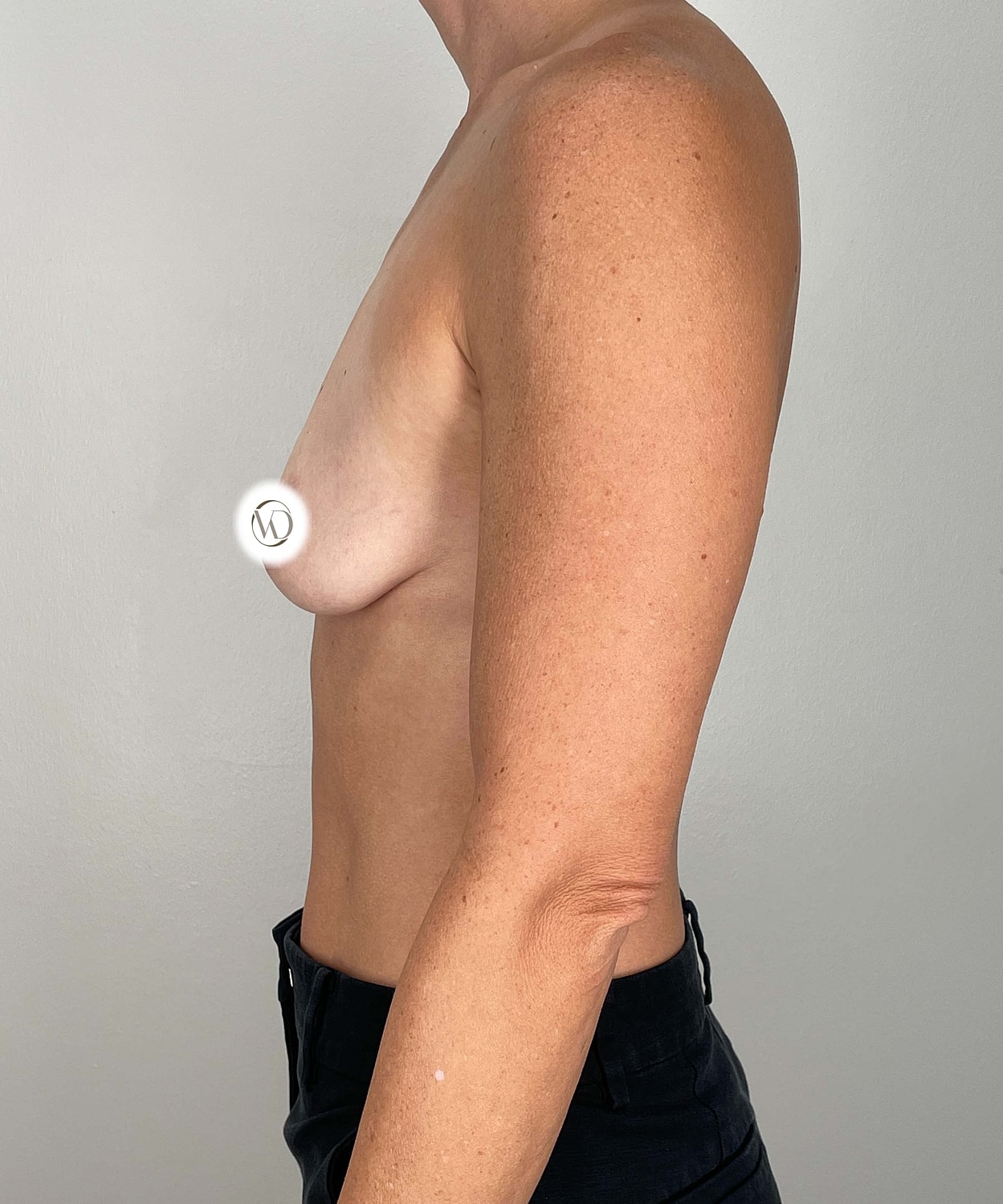 Breast Augmentation Gallery Before & After