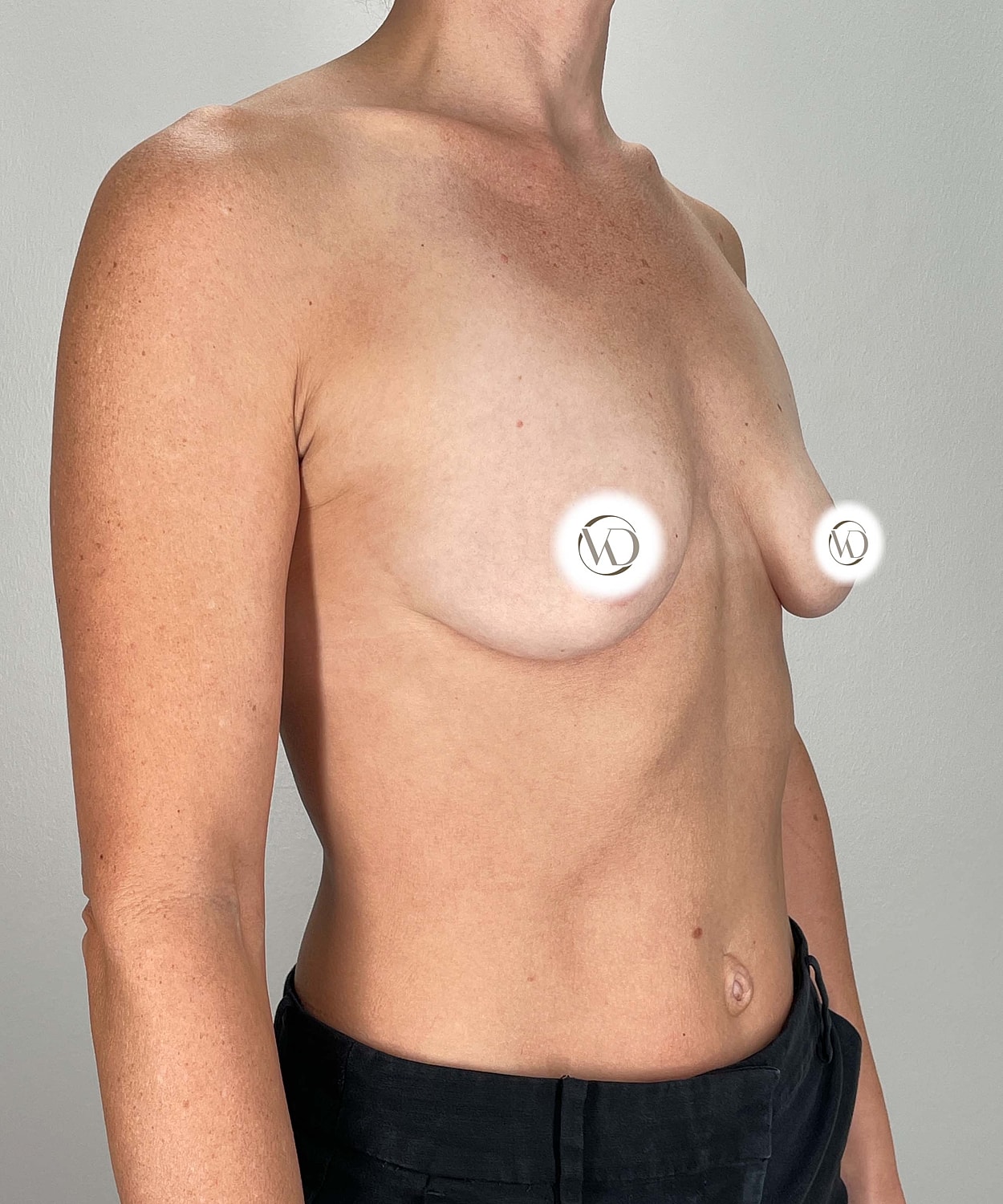 Breast Augmentation Gallery Before & After