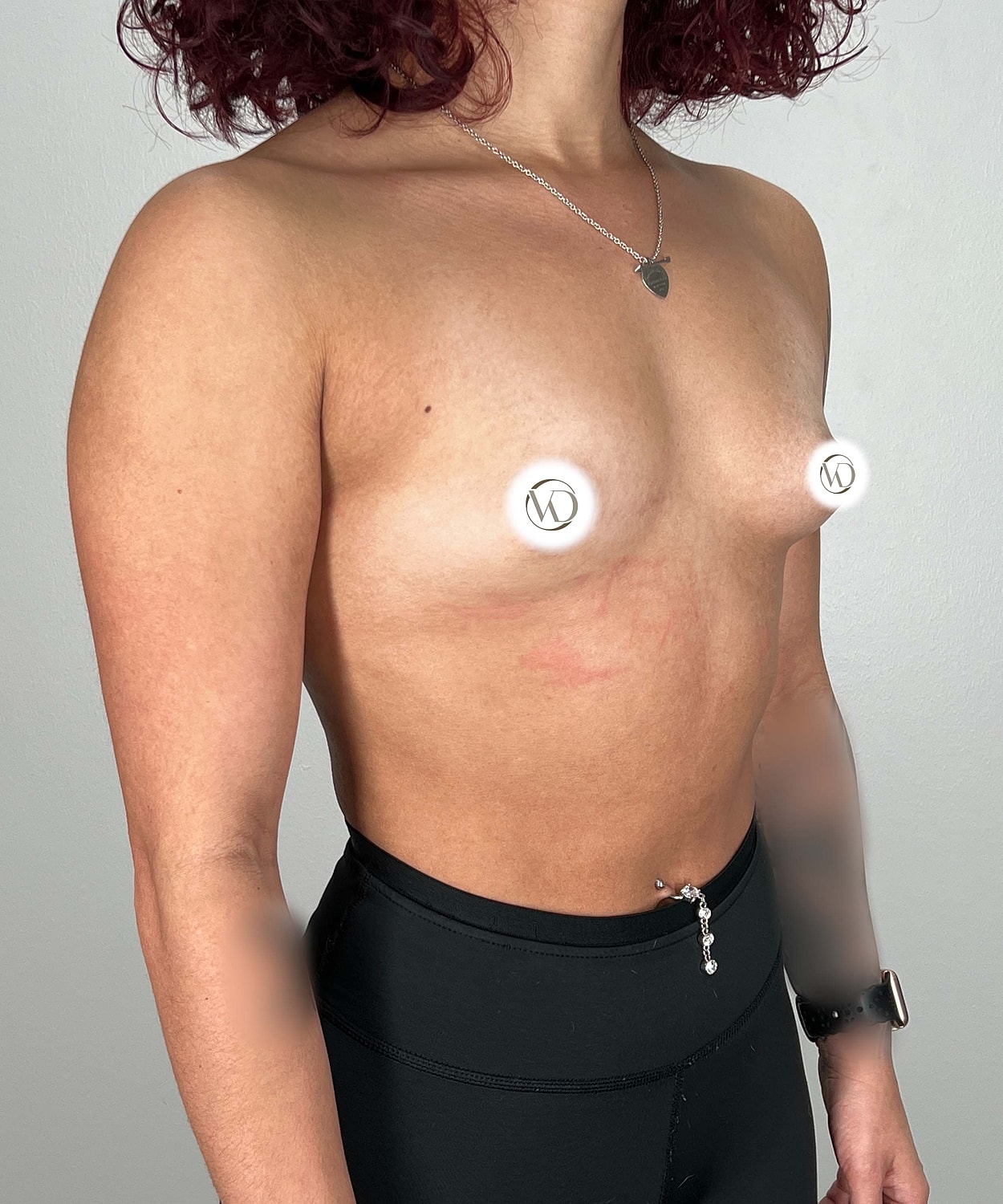 Breast Augmentation Gallery Before & After