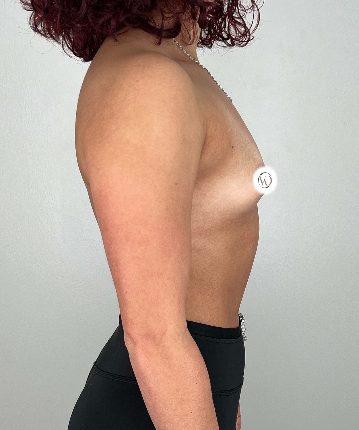 Breast Augmentation Gallery Before & After