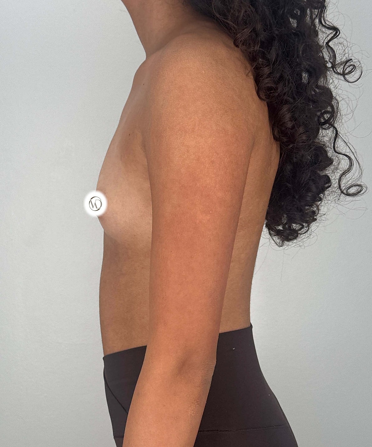 Breast Augmentation Gallery Before & After
