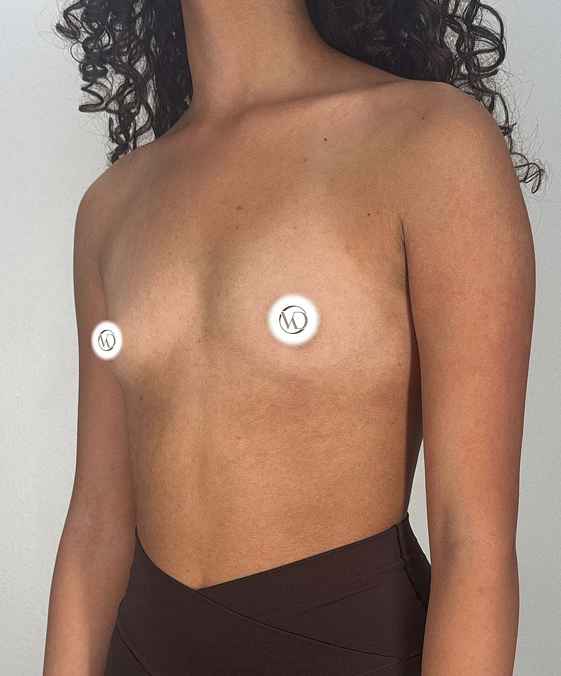 Breast Augmentation Gallery Before & After