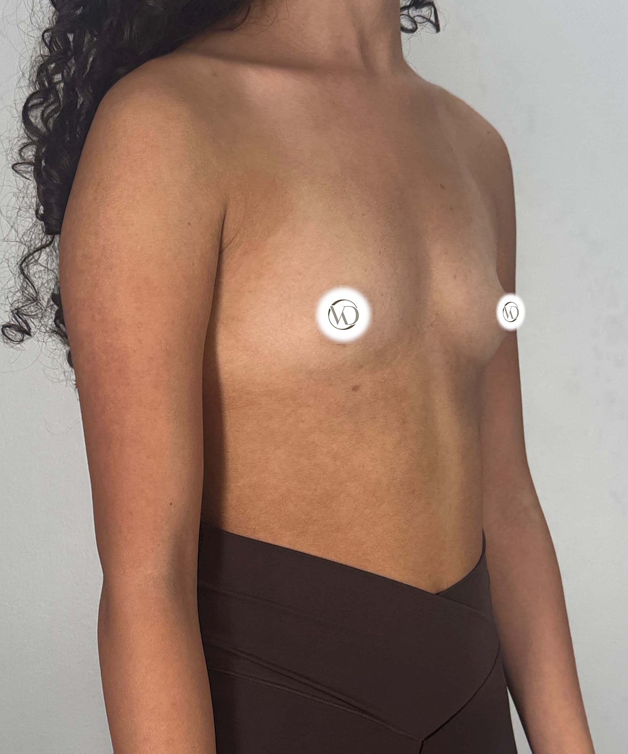 Breast Augmentation Gallery Before & After