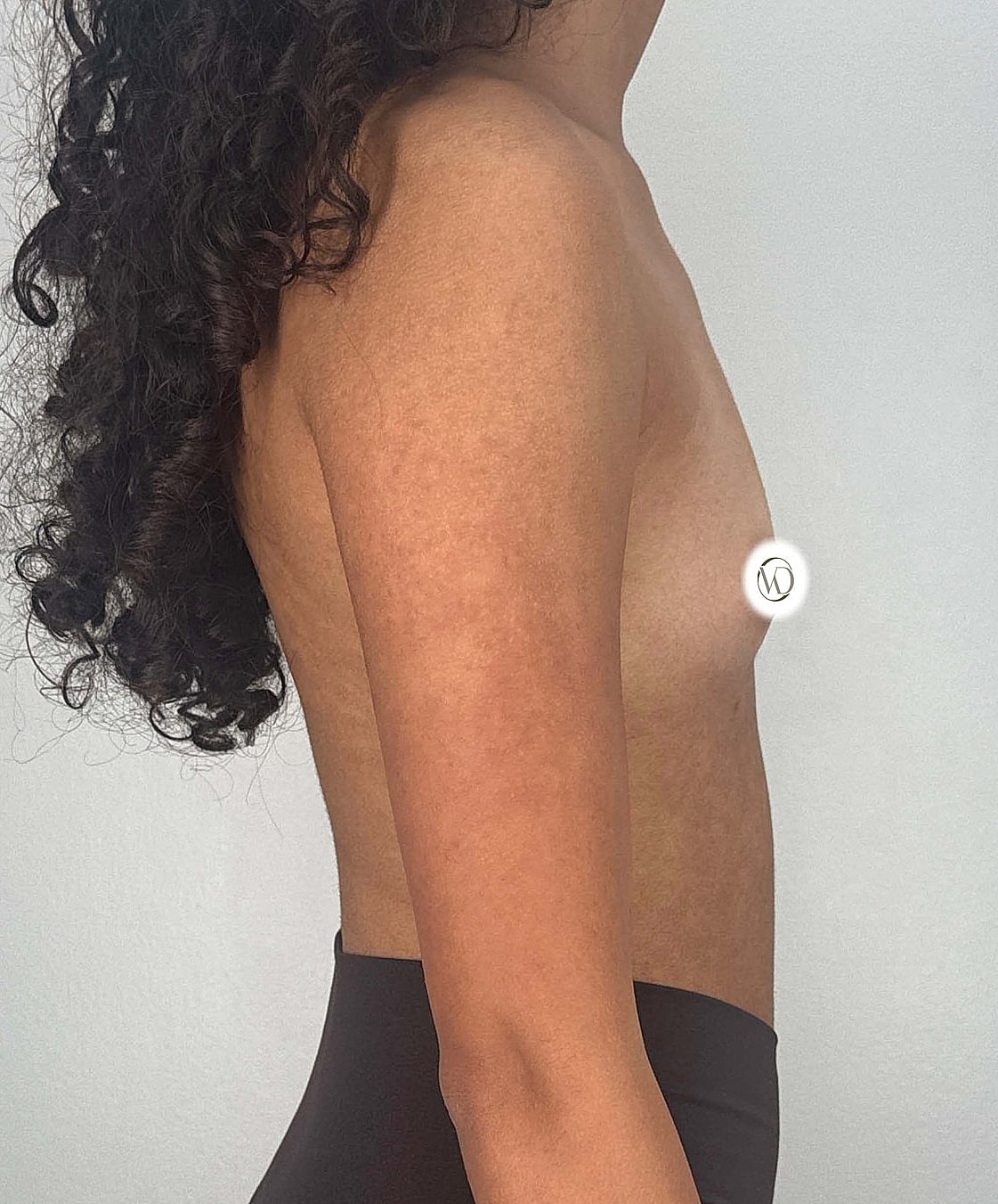 Breast Augmentation Gallery Before & After