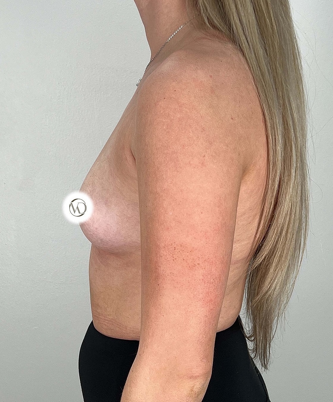 Breast Augmentation Gallery Before & After
