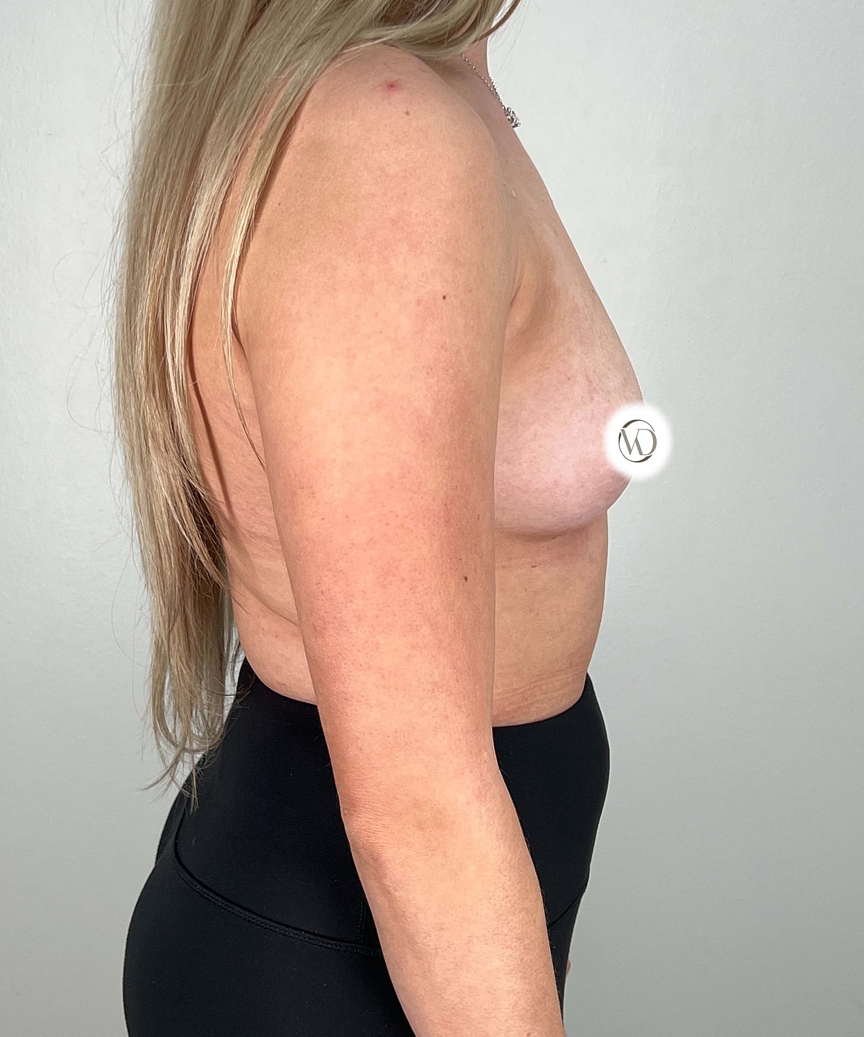 Breast Augmentation Gallery Before & After