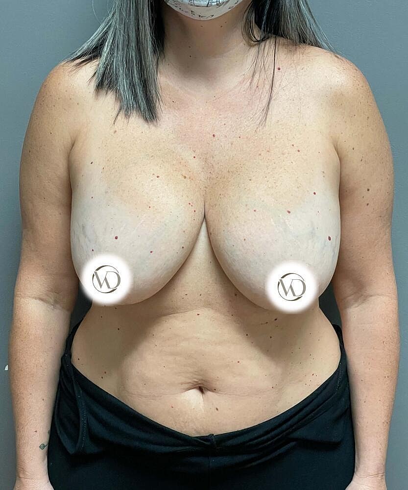 Breast Lift With Implant Removal Before & After