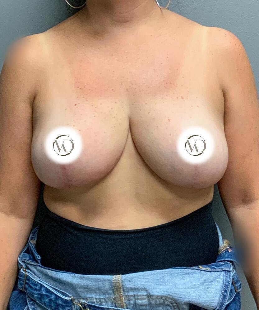 Breast Lift With Implant Removal Before & After