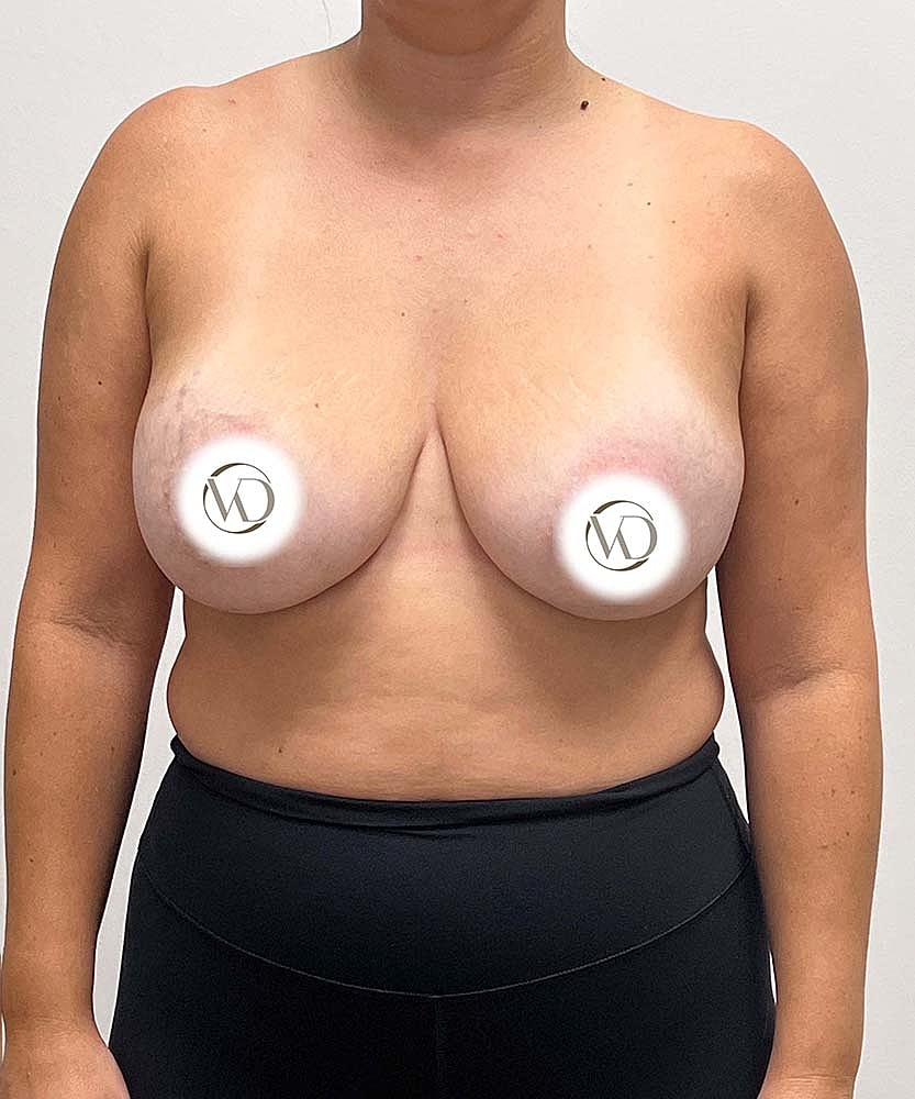 Breast Lift With Implant Removal Before & After