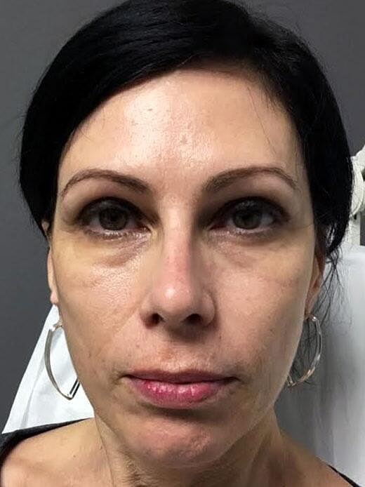 Sculptra Before & After