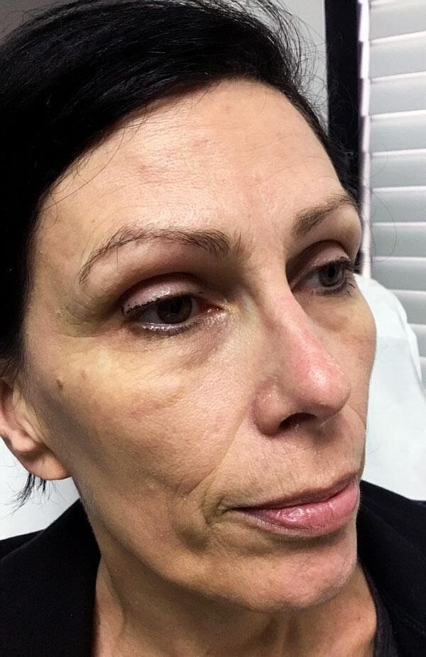Sculptra Before & After