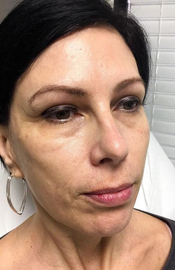 Sculptra Before & After