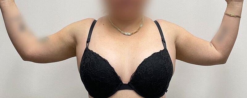 Liposuction Before & After