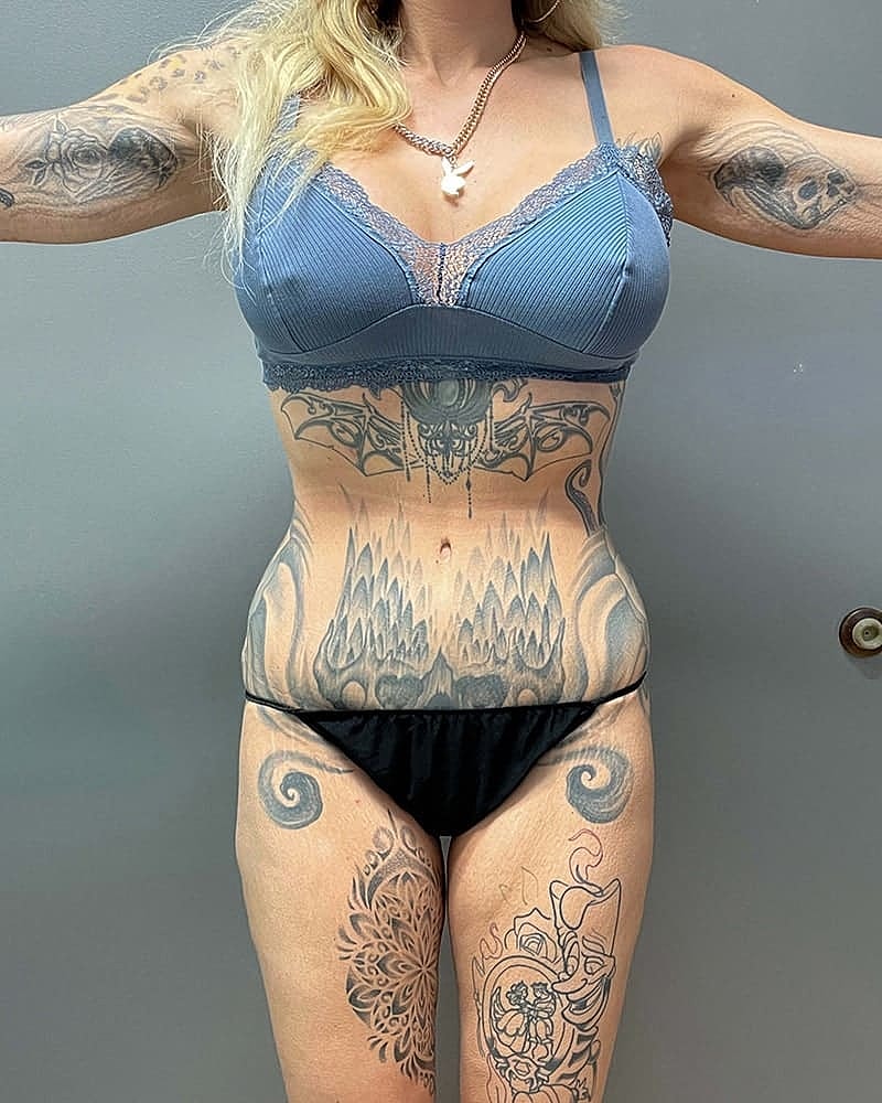 Liposuction Before & After