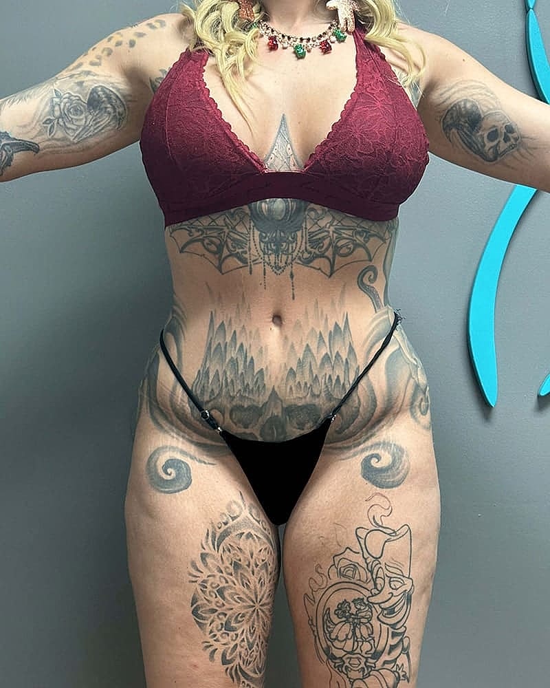 Liposuction Before & After