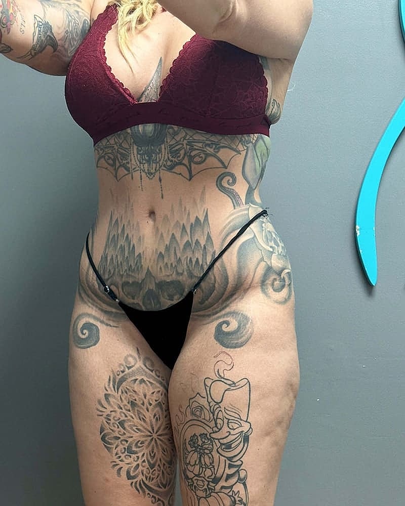 Liposuction Before & After