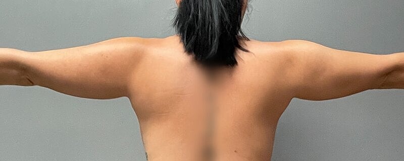 Liposuction Before & After
