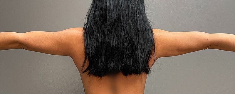 Liposuction Before & After