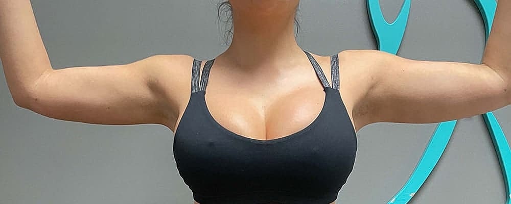 Liposuction Before & After