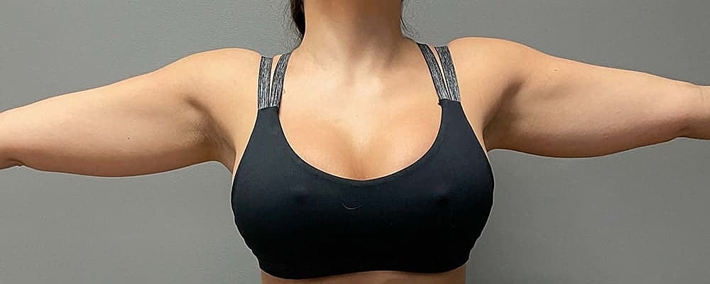 Liposuction Before & After
