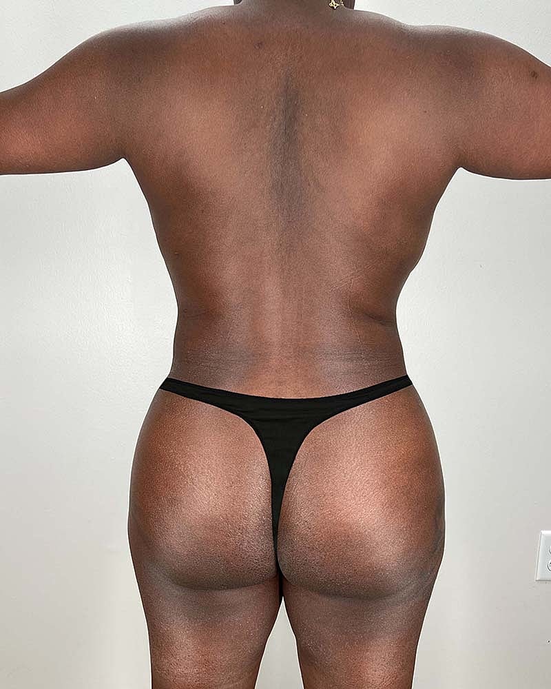 Liposuction Before & After