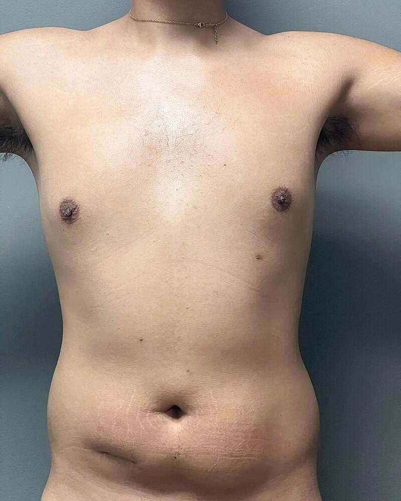 Liposuction Before & After