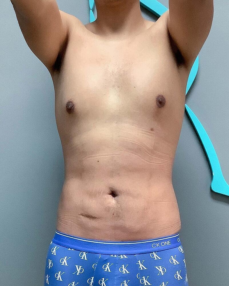 Liposuction Before & After