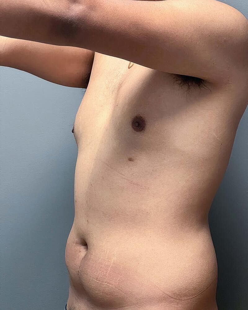 Liposuction Before & After