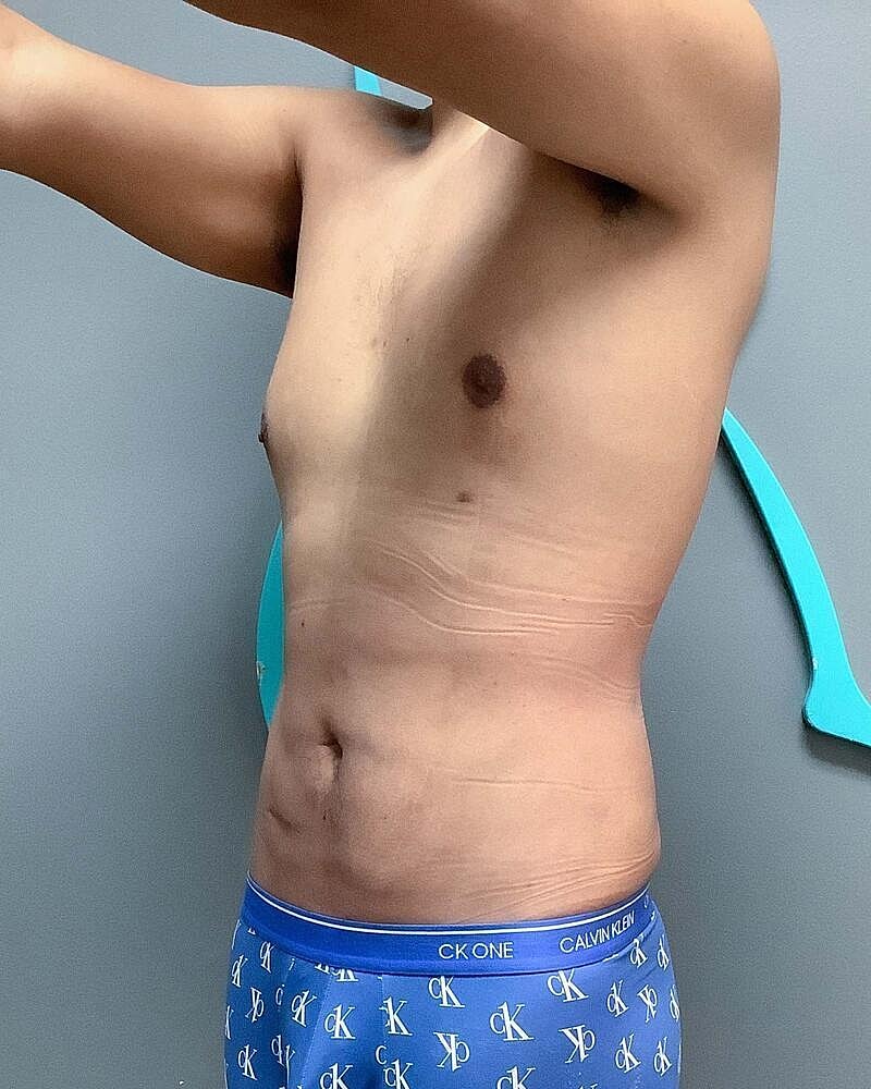 Liposuction Before & After