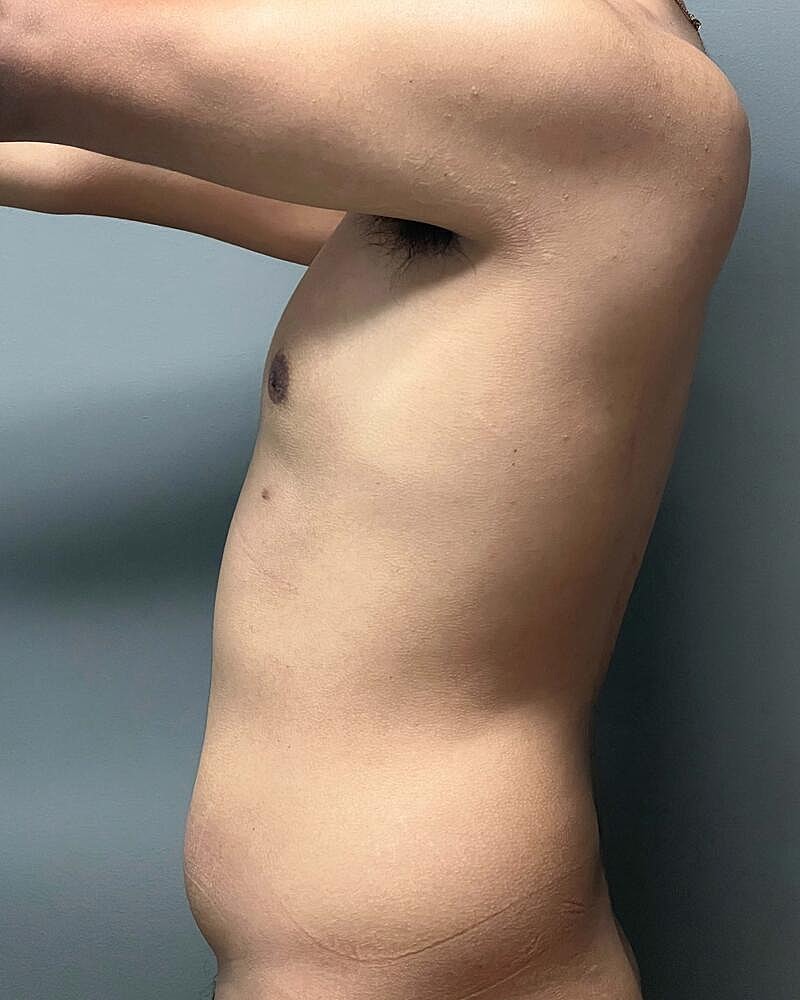 Liposuction Before & After