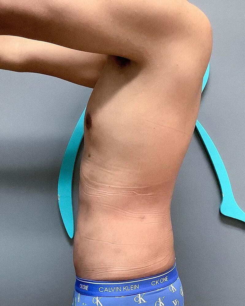 Liposuction Before & After