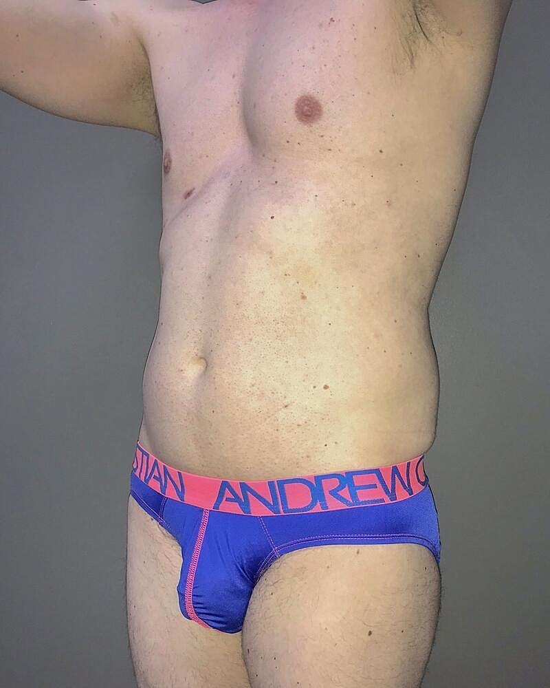 Liposuction Before & After