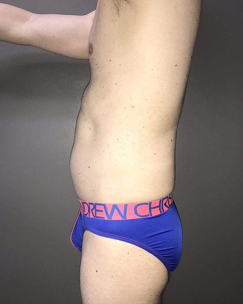 Liposuction Before & After