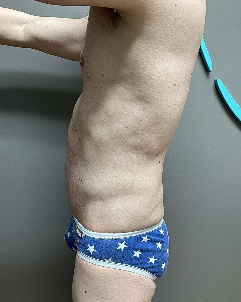 Liposuction Before & After