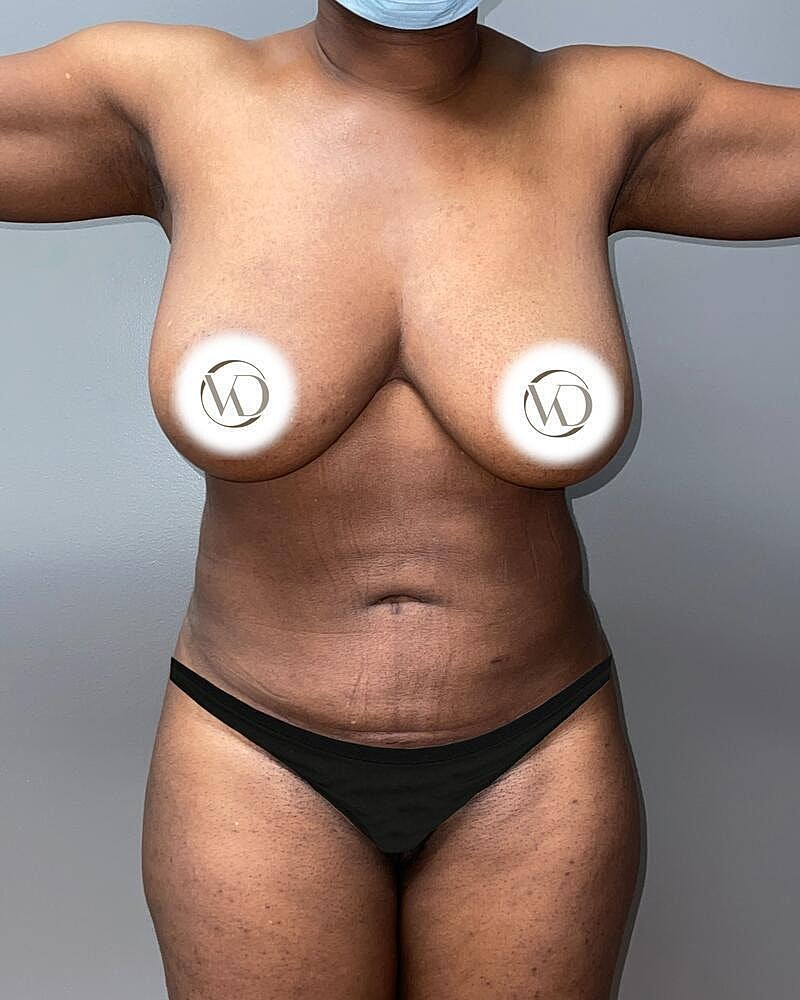Liposuction Before & After