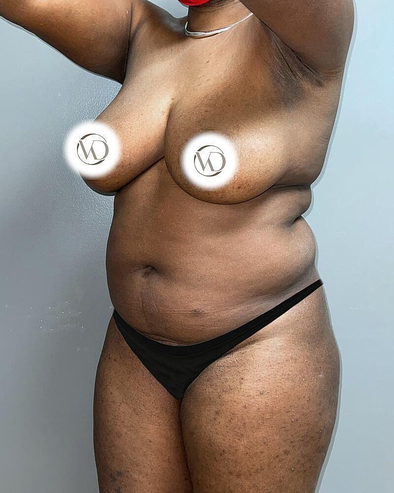 Liposuction Before & After