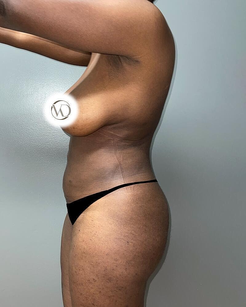 Liposuction Before & After