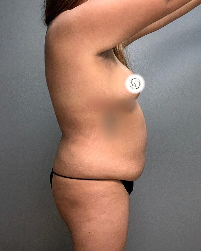 Liposuction Before & After