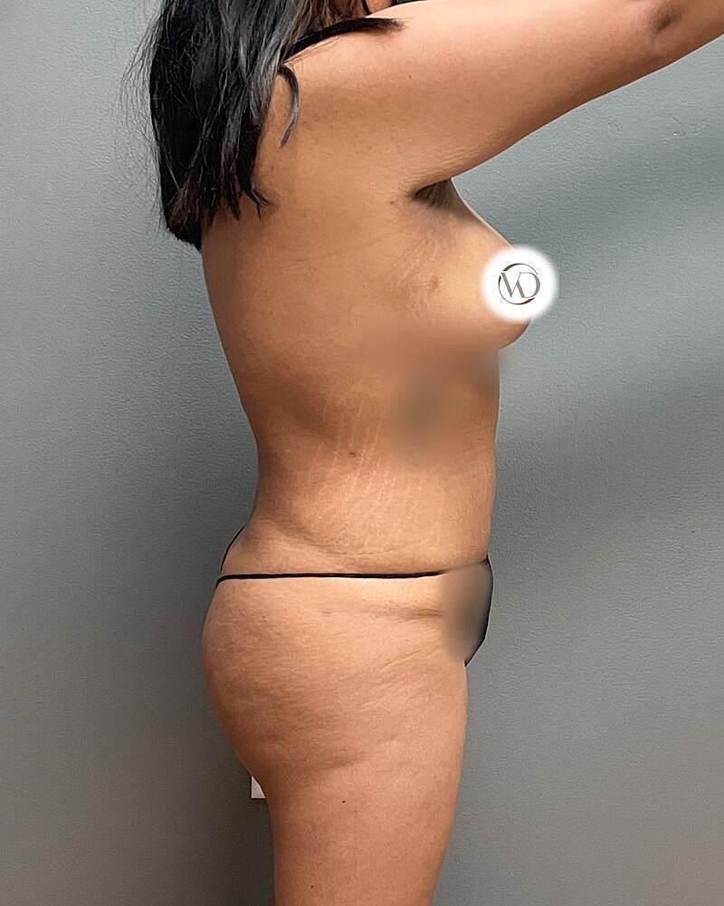 Liposuction Before & After